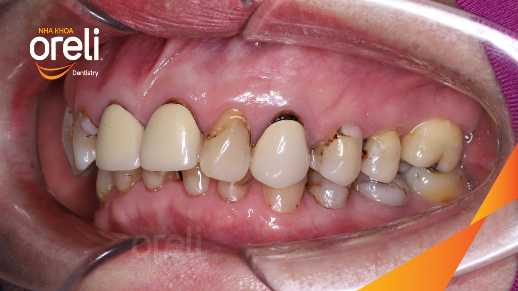 Quá trình Dán sứ Veneer thẩm mỹ với thiết kế dáng răng tự nhiên trong  tại Oreli