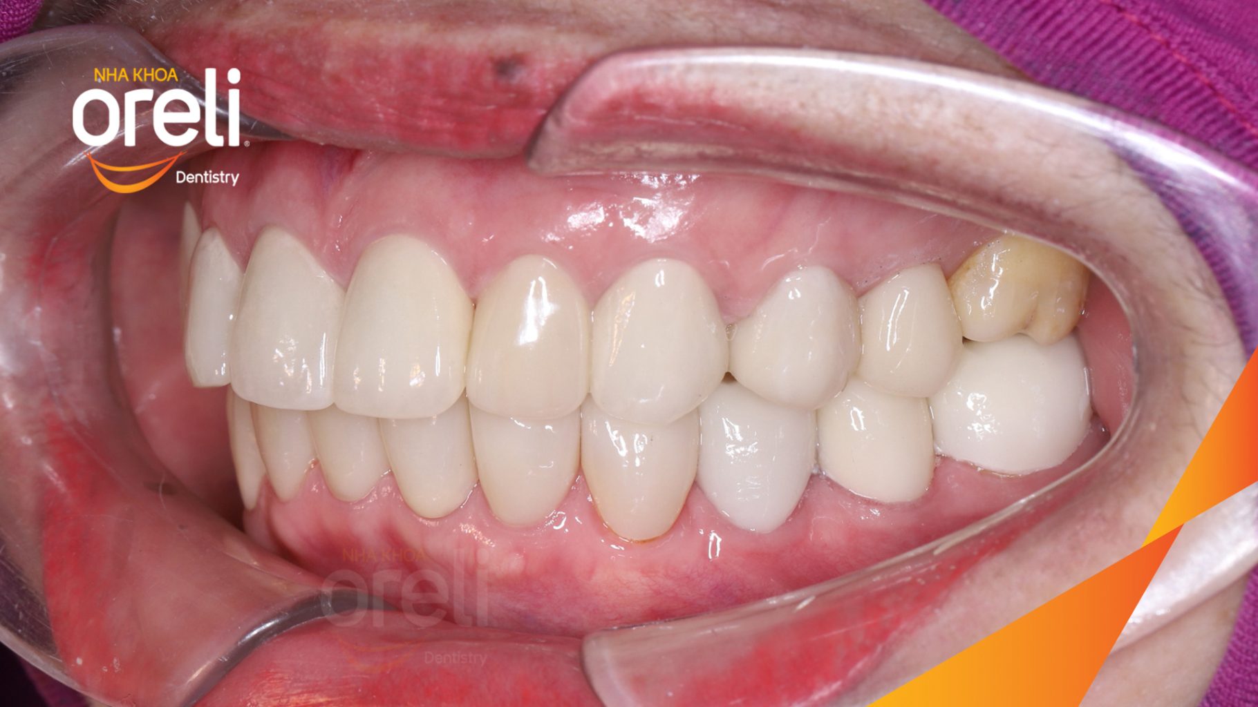 Thực hiện Dán sứ Veneer thẩm mỹ với thiết kế dáng răng tự nhiên kéo dài  tại Oreli