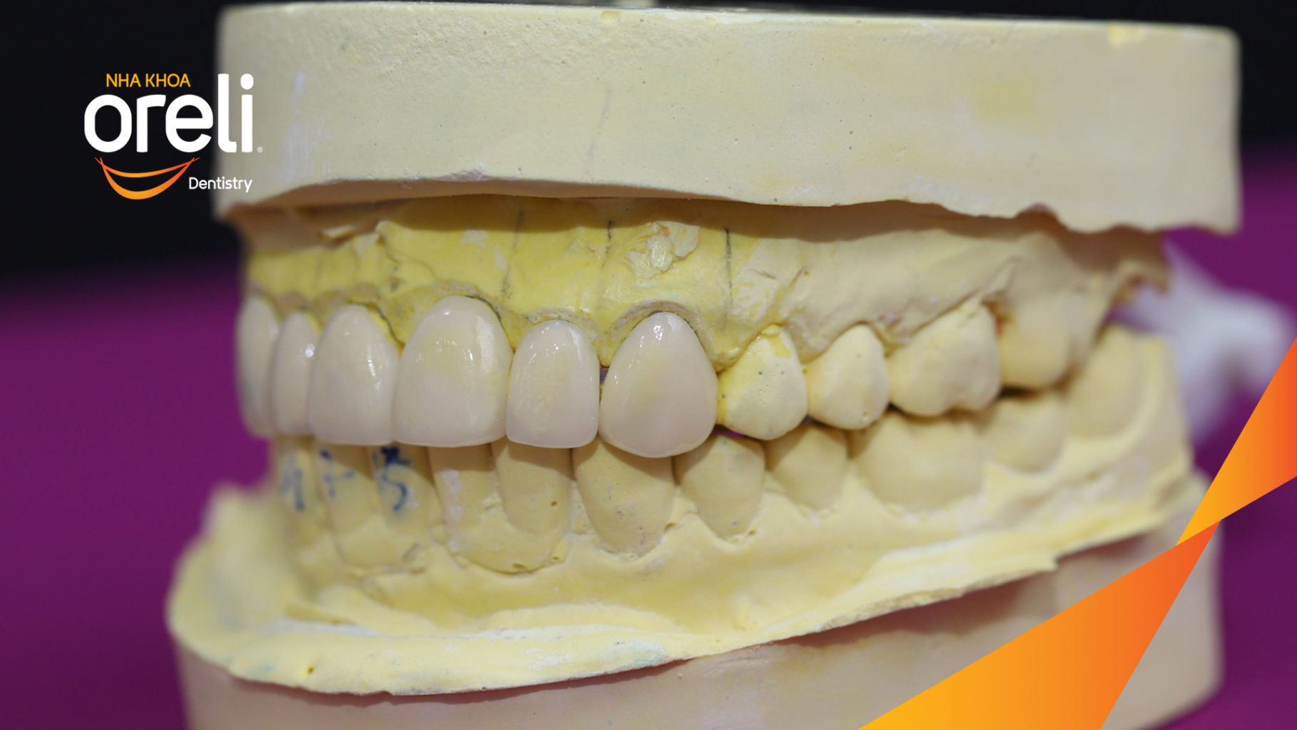 Trước điều trị: Răng xỉn màu, hình thể răng chưa cân đối tại Oreli