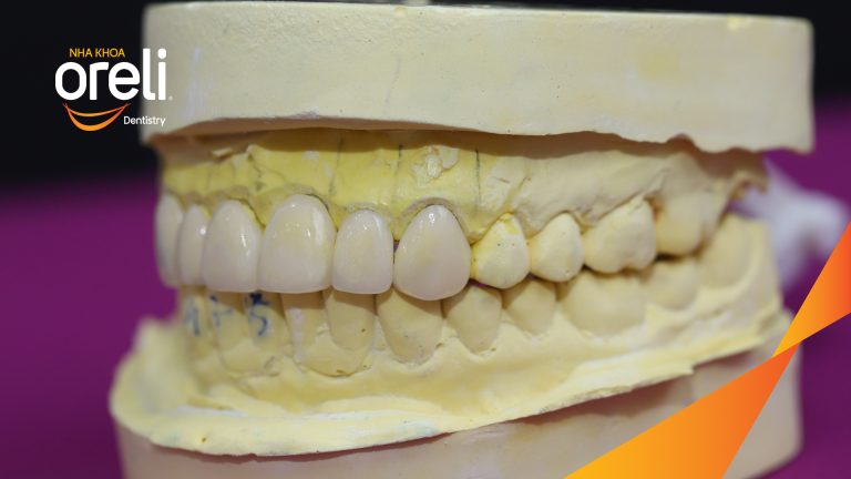 Dán sứ Veneer tại Nha khoa Oreli