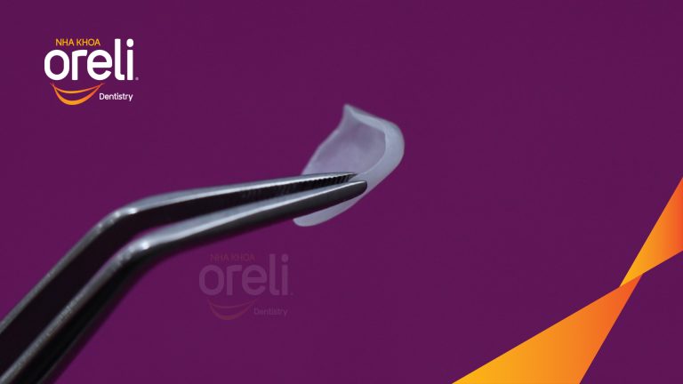 Dán sứ Veneer tại Nha khoa Oreli