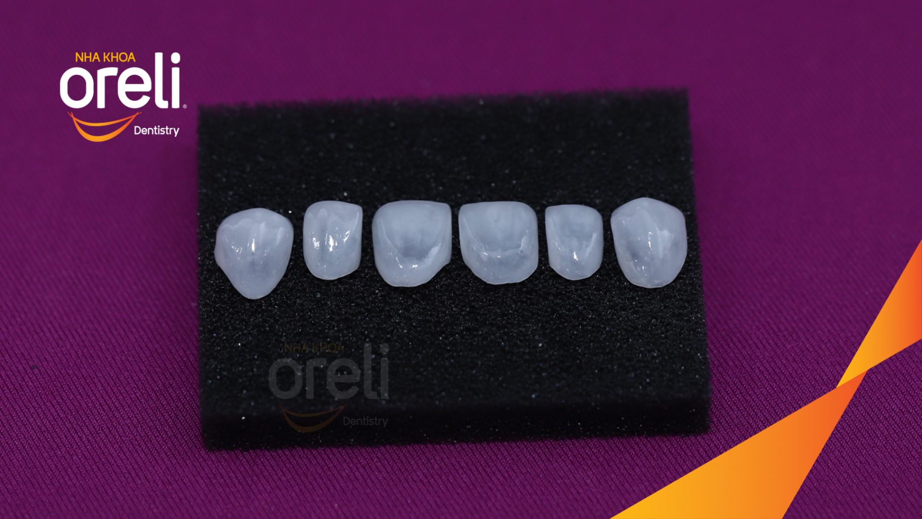Quá trình Dán sứ Veneer thẩm mỹ với độ mỏng cao trong  tại Oreli