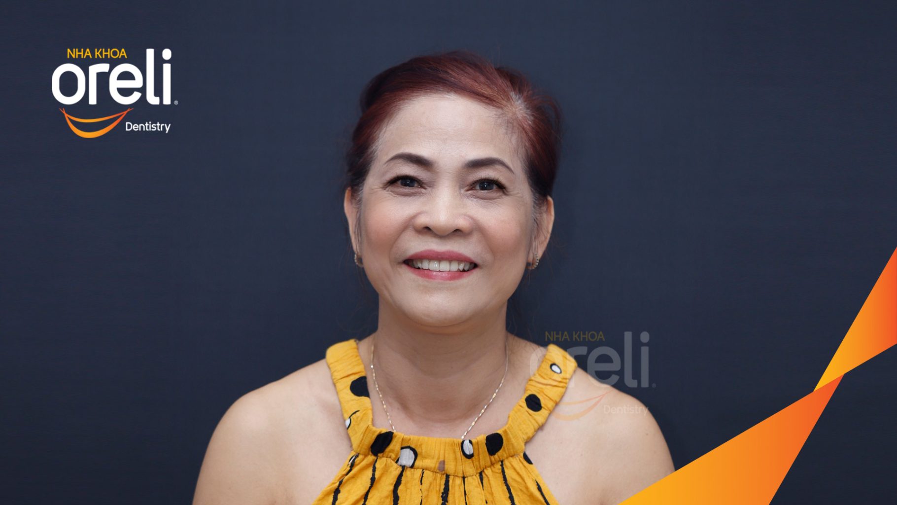 Kết quả đạt được sau  - Màu răng trắng sáng tự nhiên, nụ cười hài hòa, trẻ trung và tự tin hơn. tại Oreli