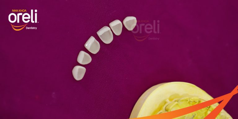 Dán sứ Veneer tại Buôn Ma Thuột | Nha khoa Oreli