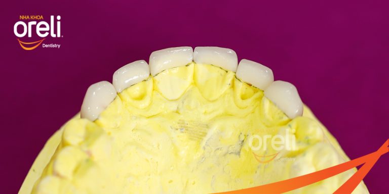Dán sứ Veneer tại Buôn Ma Thuột | Nha khoa Oreli