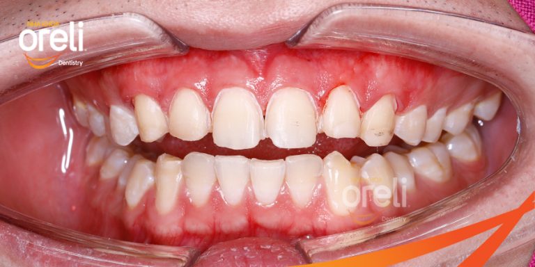 Dán sứ Veneer tại Buôn Ma Thuột | Nha khoa Oreli