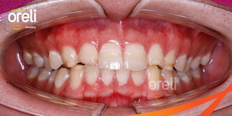 Dán sứ Veneer tại Buôn Ma Thuột | Nha khoa Oreli