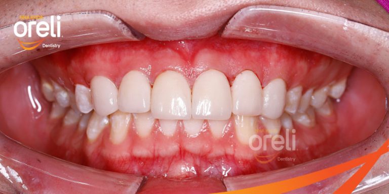 Dán sứ Veneer tại Buôn Ma Thuột | Nha khoa Oreli