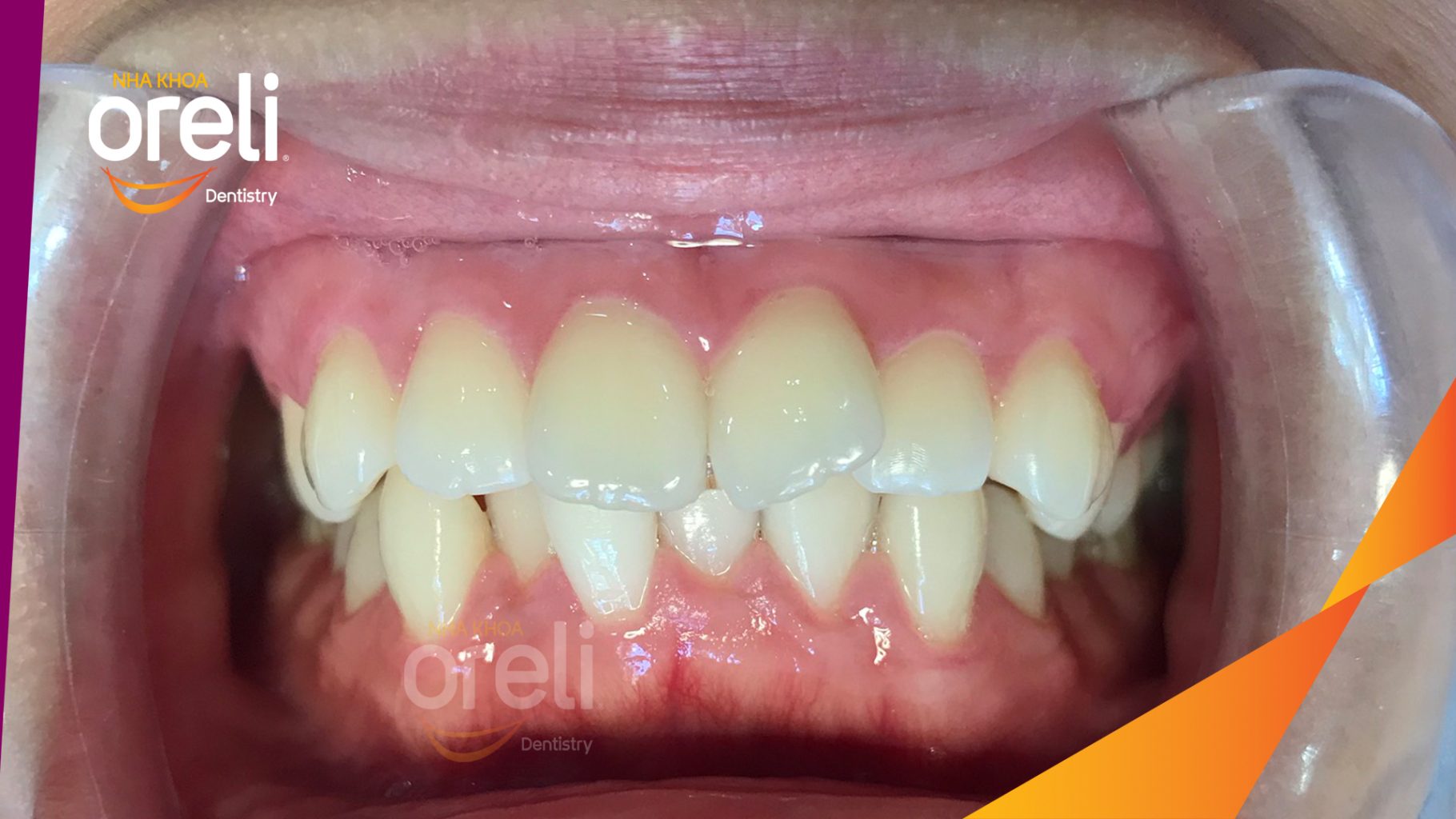 Kết quả sau 3 năm: Khớp cắn chuẩn nụ cười đẹp tại Nha khoa Oreli