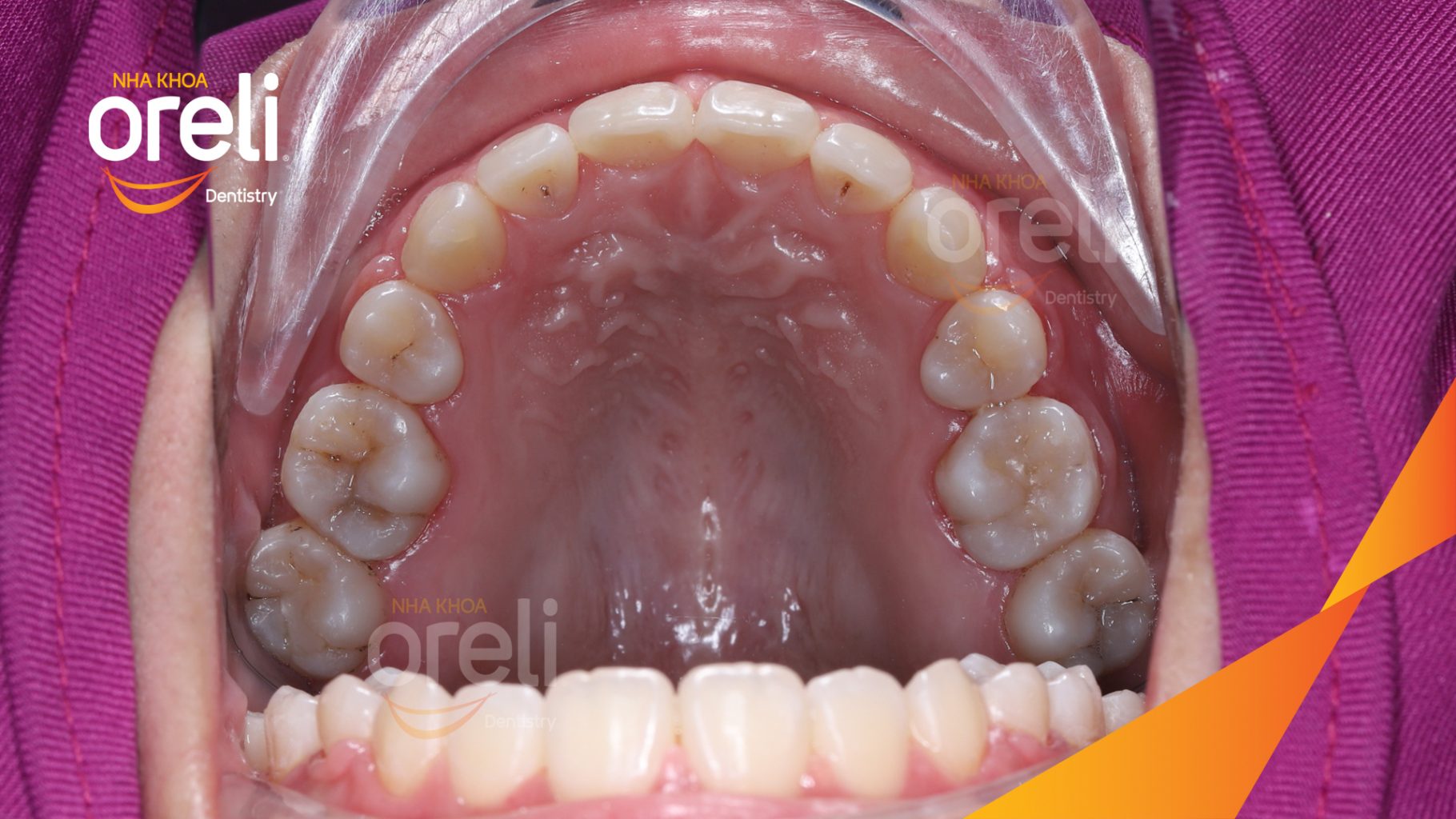 Thực hiện Nhổ 4 răng số 4 kéo dài 3 năm tại Nha khoa Oreli