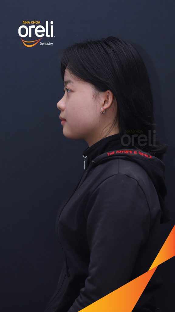 Kết quả đạt được sau 3 năm - Khớp cắn chuẩn nụ cười đẹp tại Nha khoa Oreli