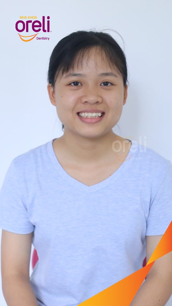 Kết quả sau 3 năm: Khớp cắn chuẩn nụ cười đẹp tại Nha khoa Oreli