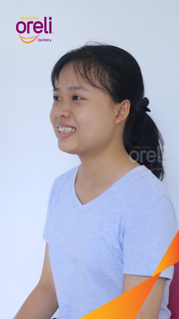 Quá trình Nhổ 4 răng số 4 trong 3 năm tại Nha khoa Oreli