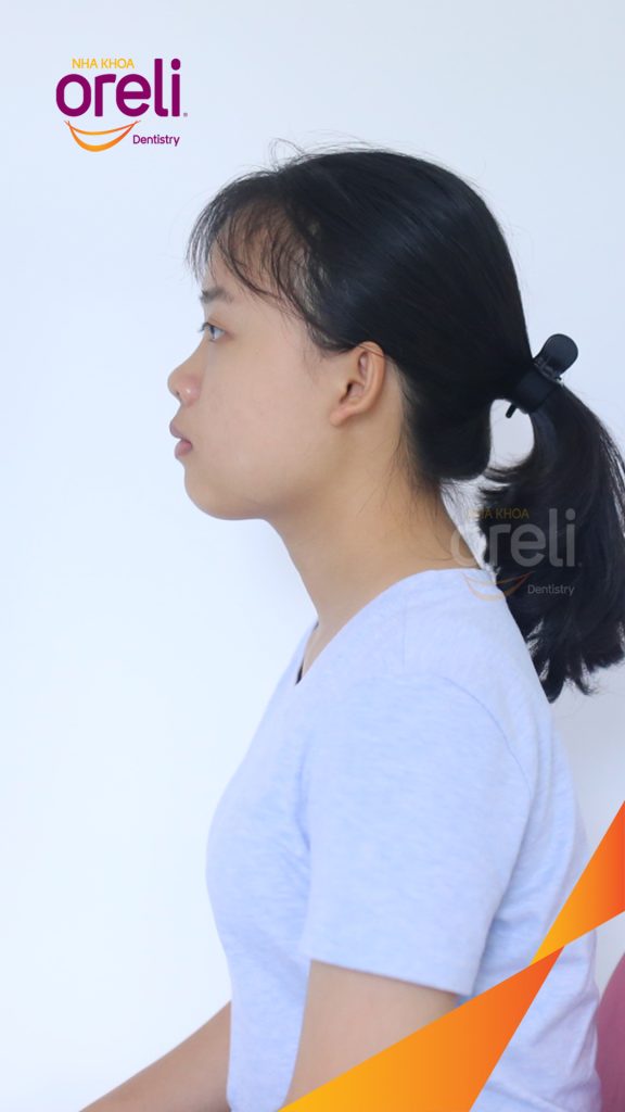 Kết quả sau 3 năm: Khớp cắn chuẩn nụ cười đẹp tại Nha khoa Oreli