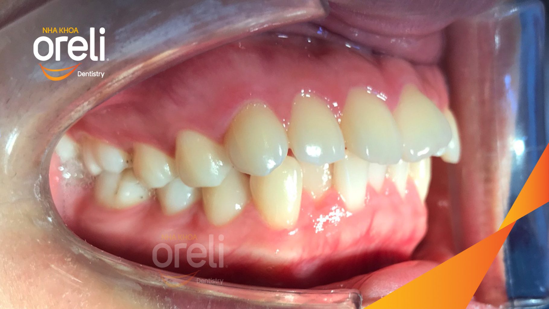 Trước điều trị: Răng chen chúc khấp khểnh hô tại Nha khoa Oreli