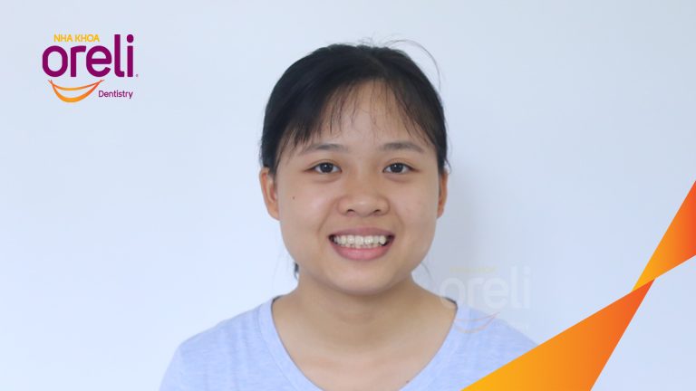 Ca niềng răng hô chen chúc nhổ 4r4 cho nụ cười đẹp ở Oreli