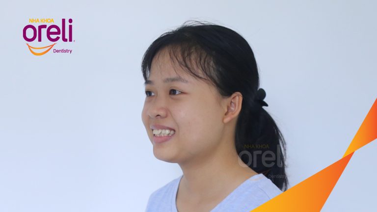 Ca niềng răng hô chen chúc nhổ 4r4 cho nụ cười đẹp ở Oreli
