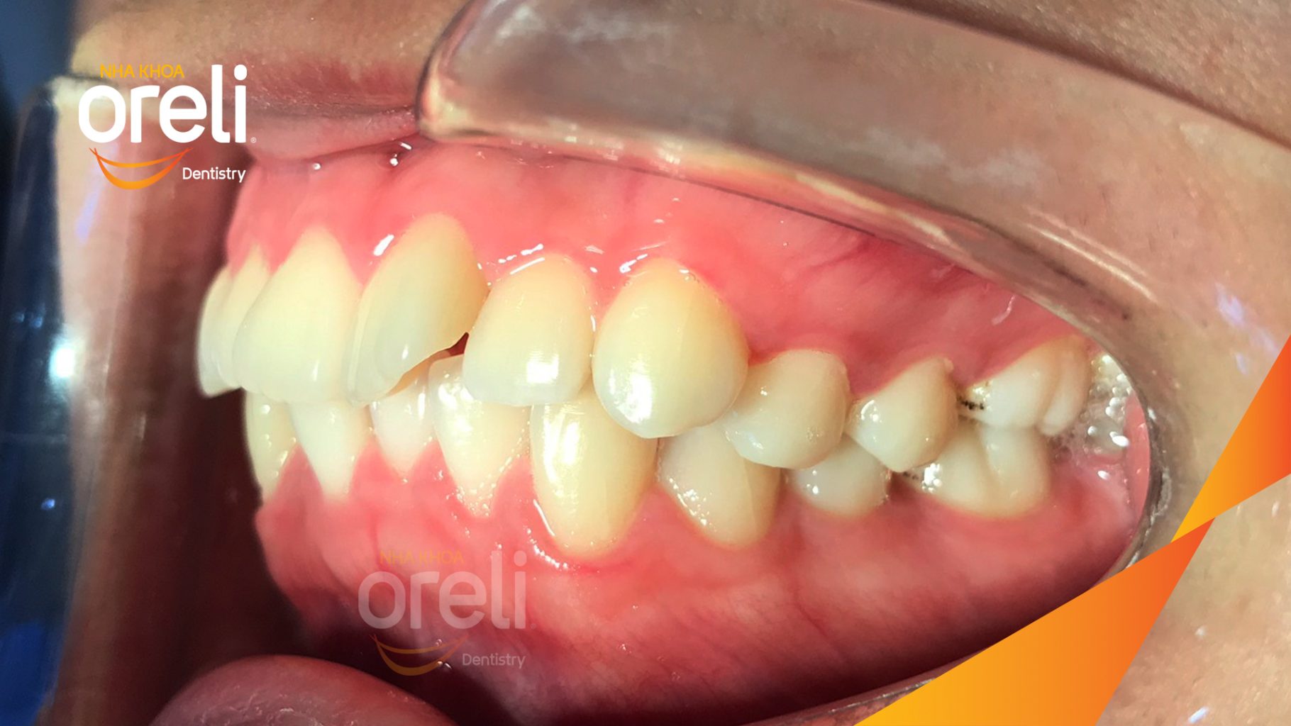 Quá trình Nhổ 4 răng số 4 trong 3 năm tại Nha khoa Oreli