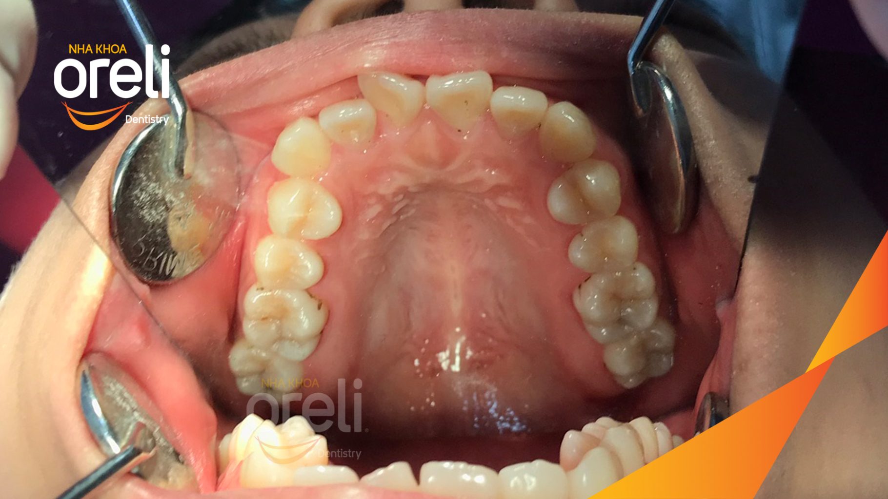 Quá trình Nhổ 4 răng số 4 trong 3 năm tại Nha khoa Oreli