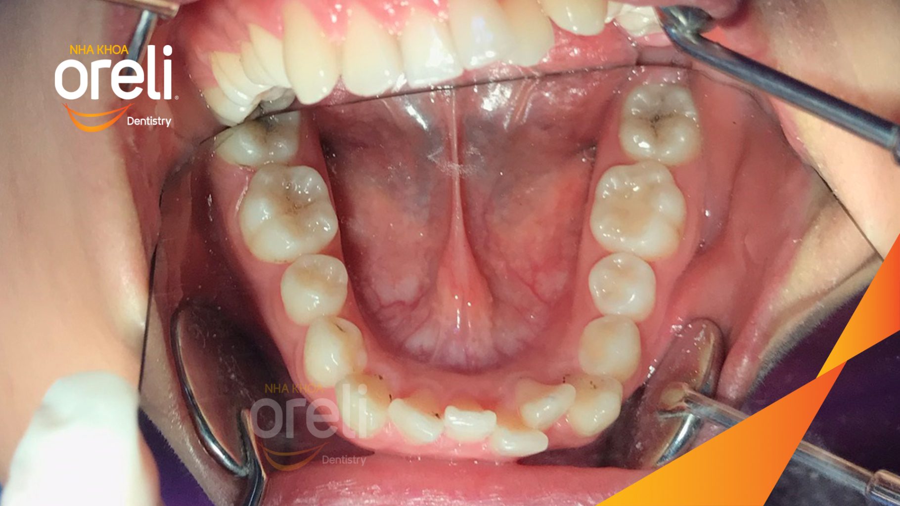 Trước điều trị: Răng chen chúc khấp khểnh hô tại Nha khoa Oreli