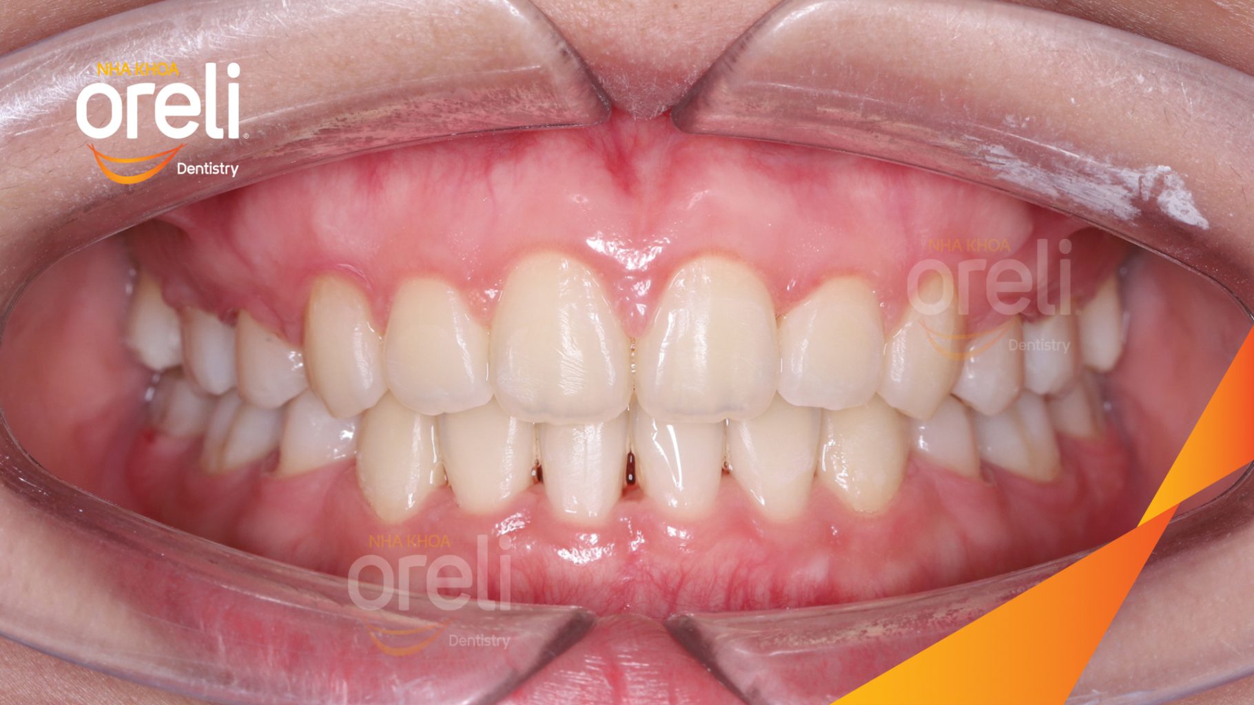 Kết quả đạt được sau 3 năm - Khớp cắn chuẩn nụ cười đẹp tại Nha khoa Oreli