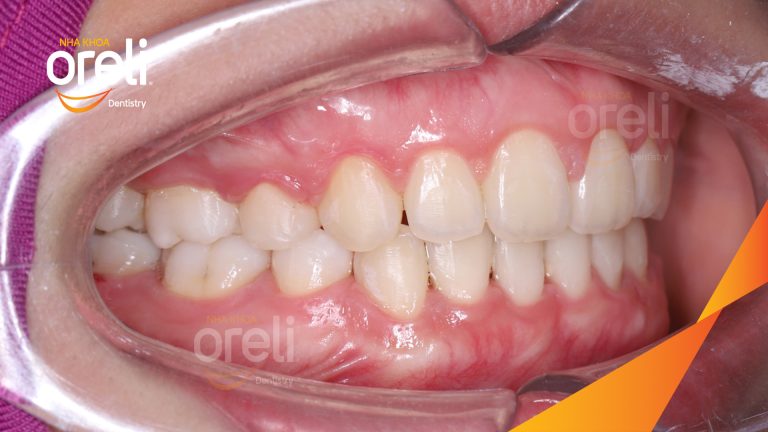 Ca niềng răng hô chen chúc nhổ 4r4 cho nụ cười đẹp ở Oreli
