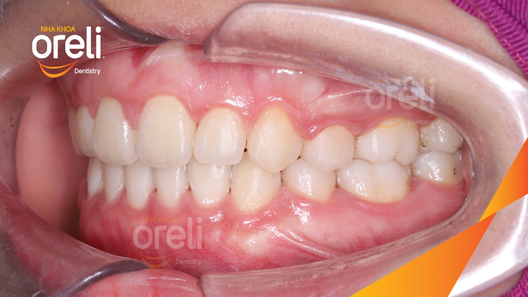 Thực hiện Nhổ 4 răng số 4 kéo dài 3 năm tại Nha khoa Oreli