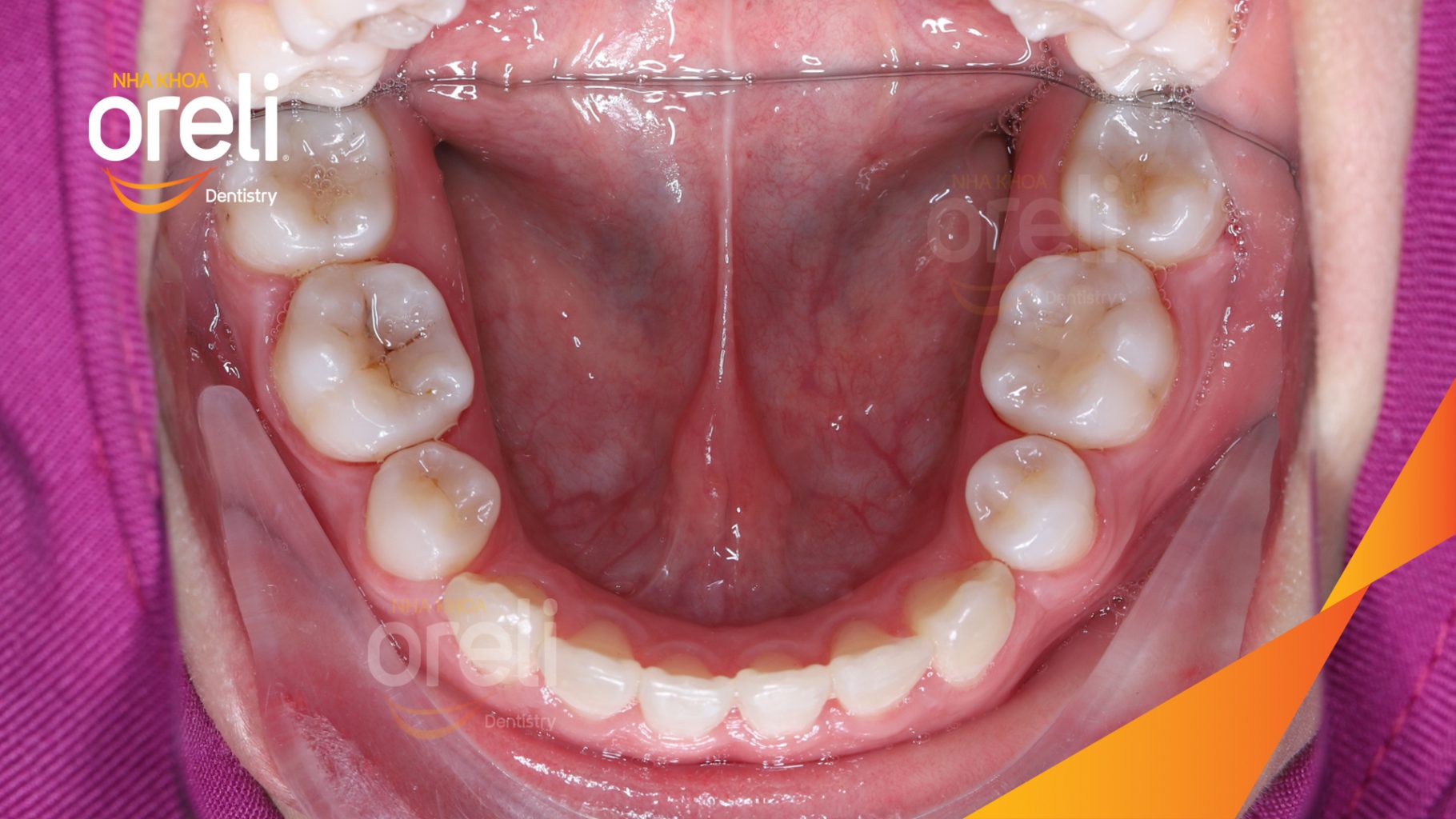 Răng chen chúc khấp khểnh hô trước khi điều trị tại Nha khoa Oreli