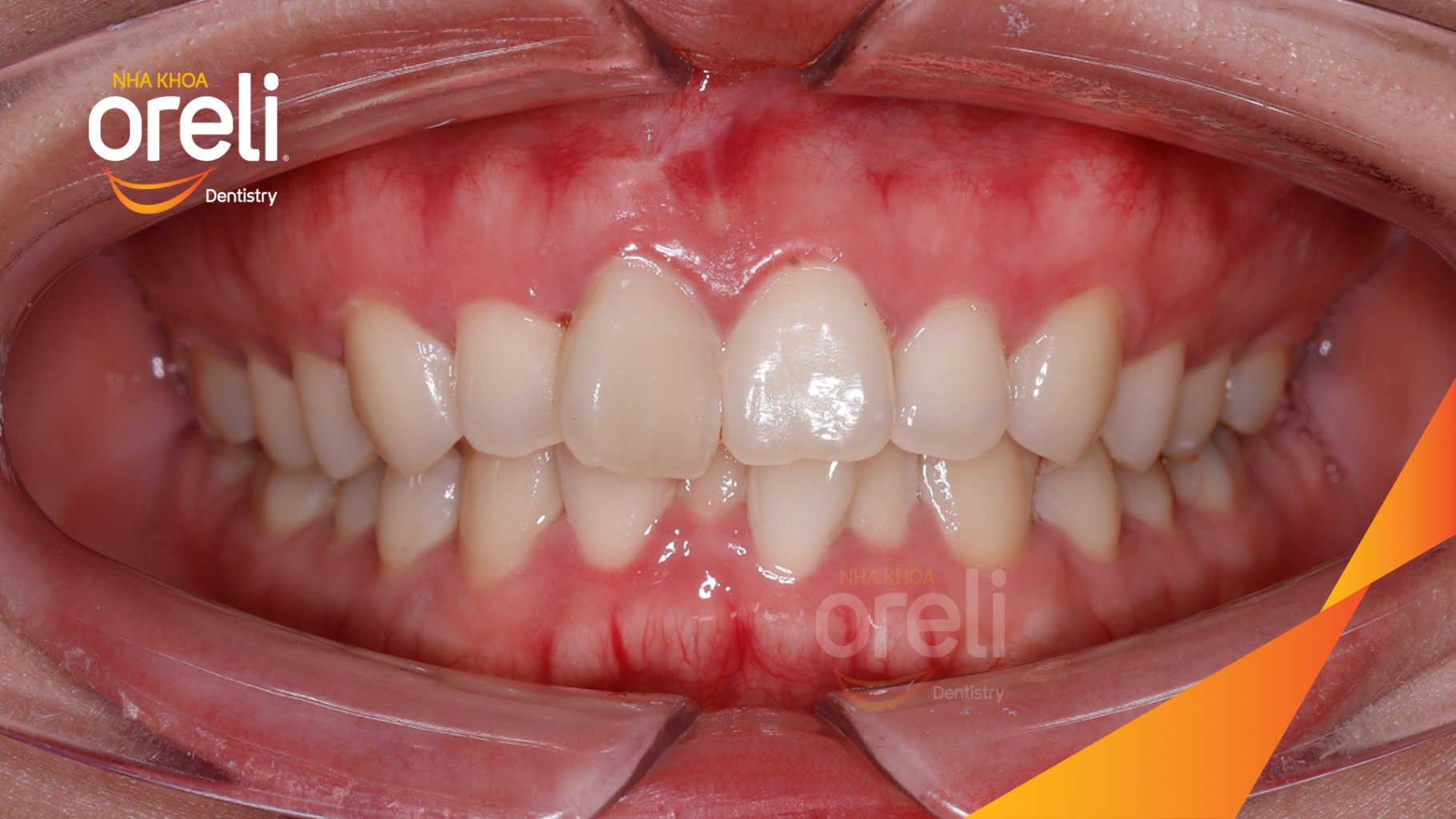 Trước điều trị: Răng chen chúc, răng cửa hàm trên xoay, hàm dưới chen chúc nặng tại Nha khoa Oreli