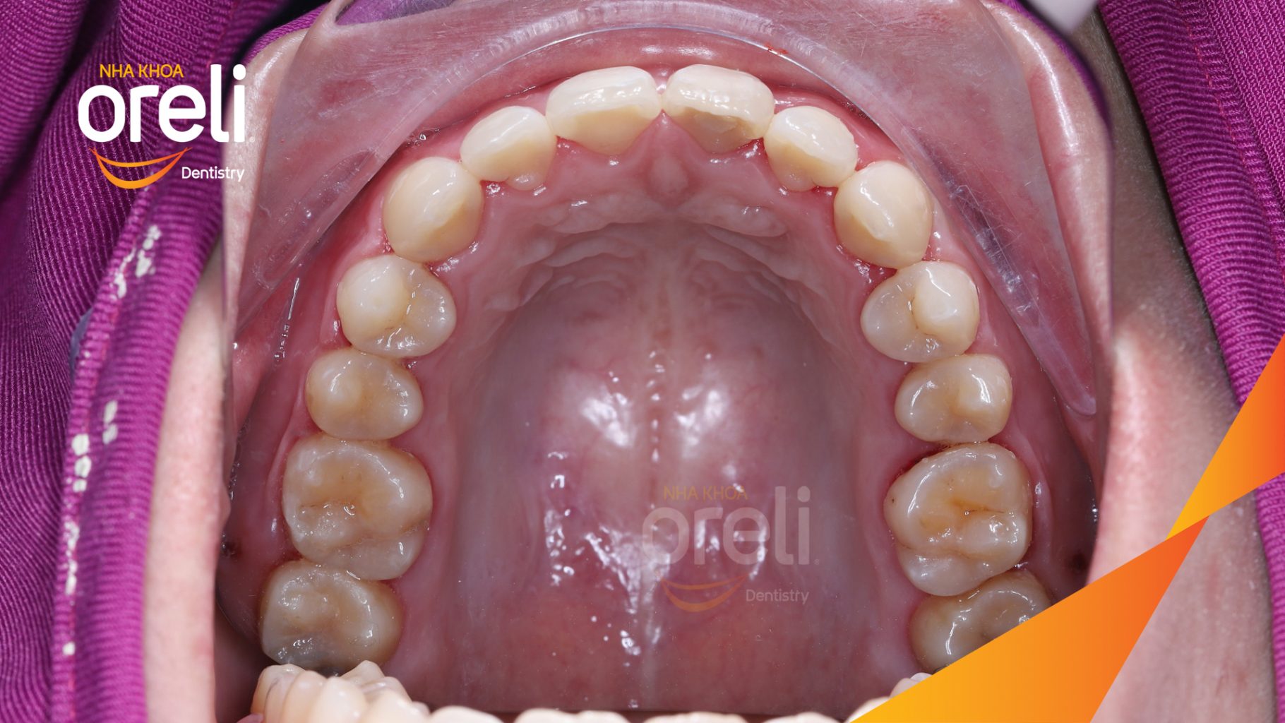 Kết quả đạt được sau 2 năm - Khớp cắn đúng nụ cười đẹp tại Nha khoa Oreli