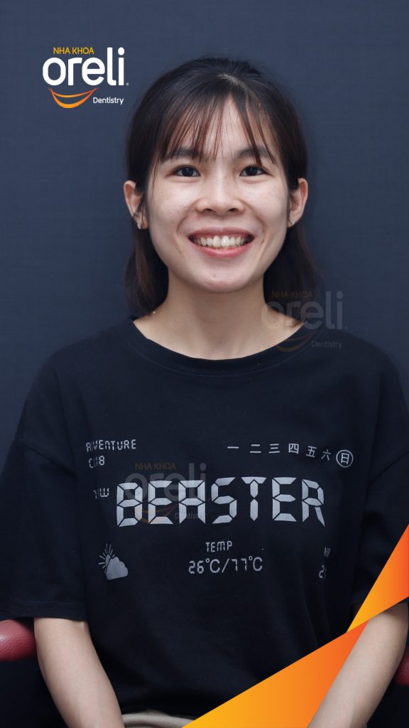 Trước điều trị: Răng chen chúc, răng cửa hàm trên xoay, hàm dưới chen chúc nặng tại Nha khoa Oreli