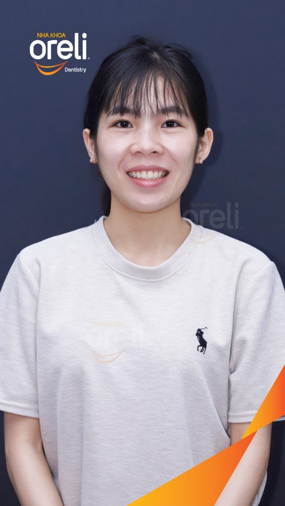 Răng chen chúc, răng cửa hàm trên xoay, hàm dưới chen chúc nặng trước khi điều trị tại Nha khoa Oreli