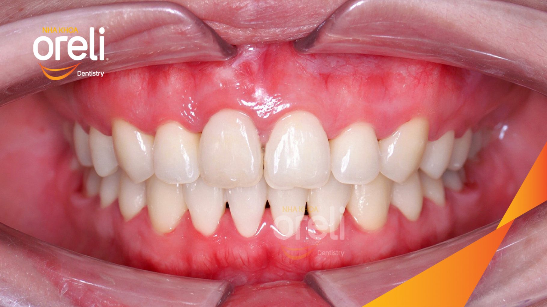 Răng chen chúc, răng cửa hàm trên xoay, hàm dưới chen chúc nặng trước khi điều trị tại Nha khoa Oreli