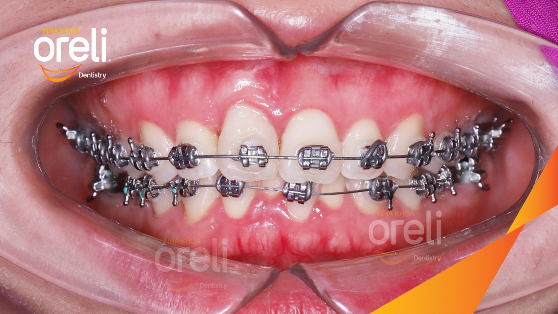 Răng chen chúc, răng cửa hàm trên xoay, hàm dưới chen chúc nặng trước khi điều trị tại Nha khoa Oreli