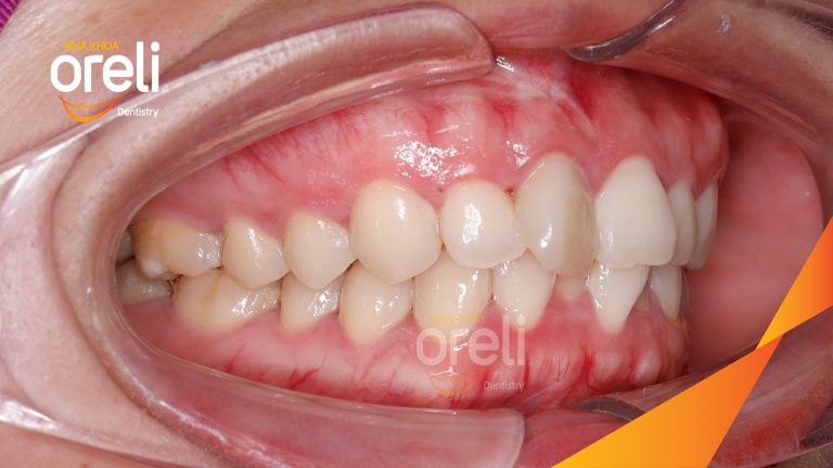 Niềng răng không nhổ răng cho nụ cười đẹp ở Oreli
