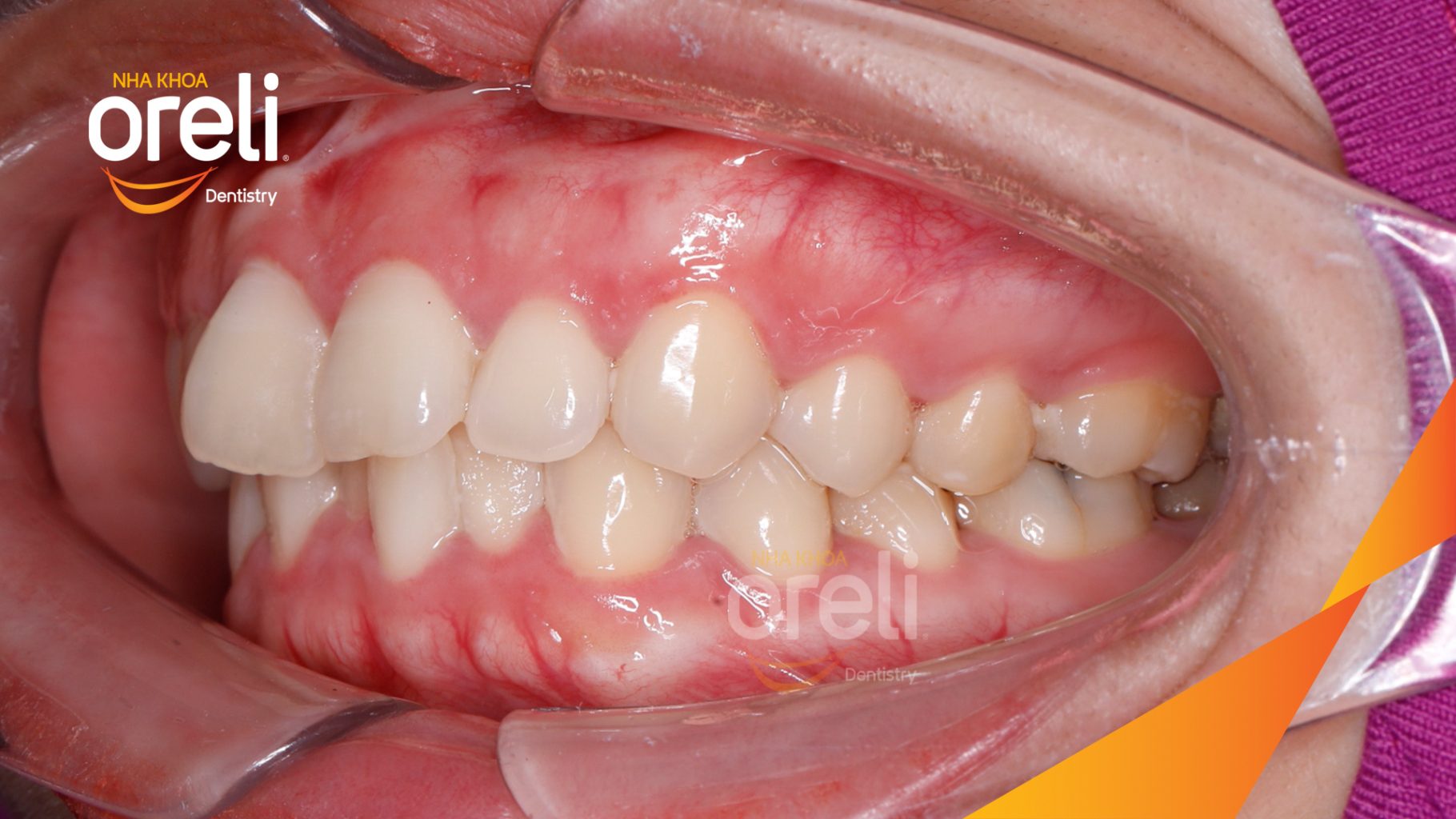 Kết quả sau 2 năm: Khớp cắn đúng nụ cười đẹp tại Nha khoa Oreli