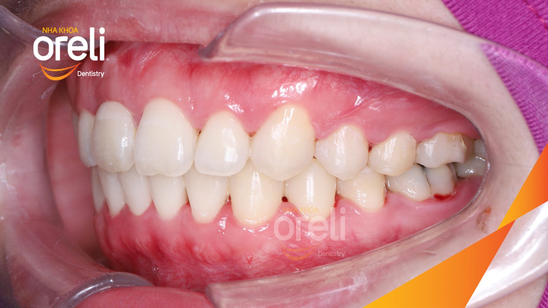 Kết quả đạt được sau 2 năm - Khớp cắn đúng nụ cười đẹp tại Nha khoa Oreli