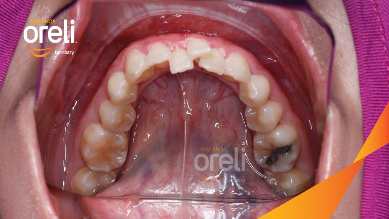 Niềng răng không nhổ răng cho nụ cười đẹp ở Oreli