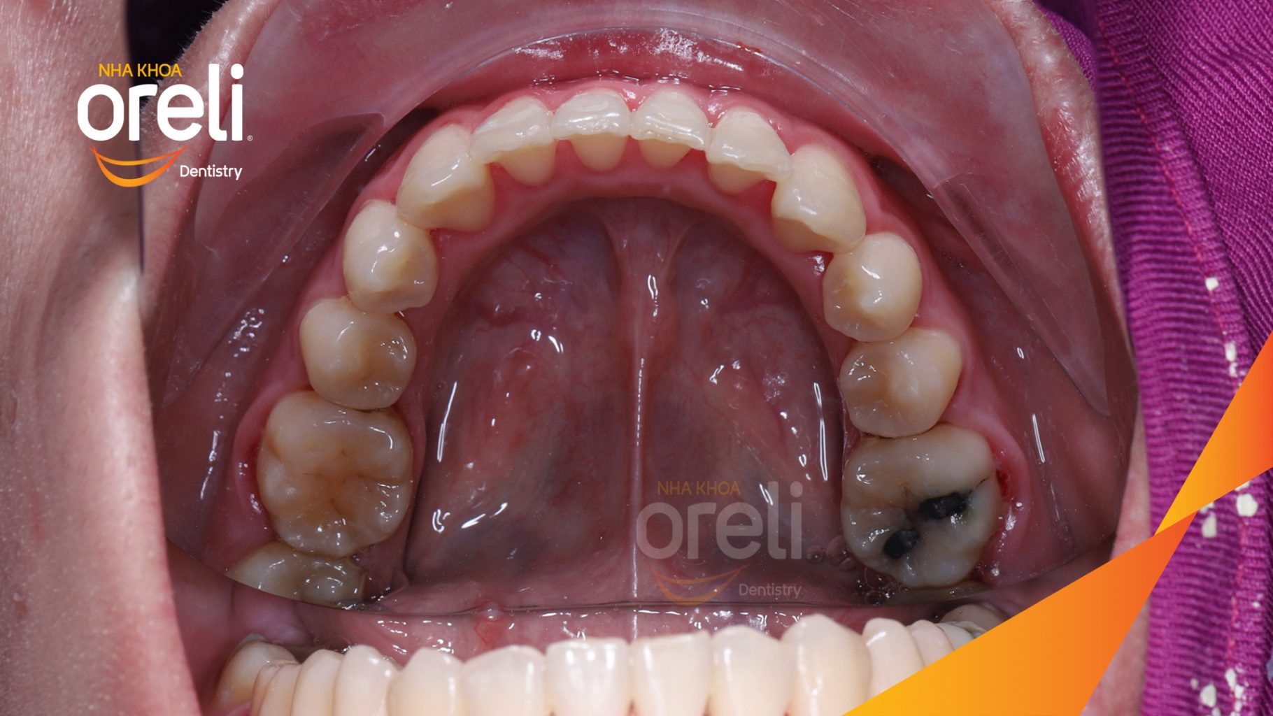 Thực hiện Nong hàm, di xa niềng làm đều và chỉnh khớp cắn kéo dài 2 năm tại Nha khoa Oreli