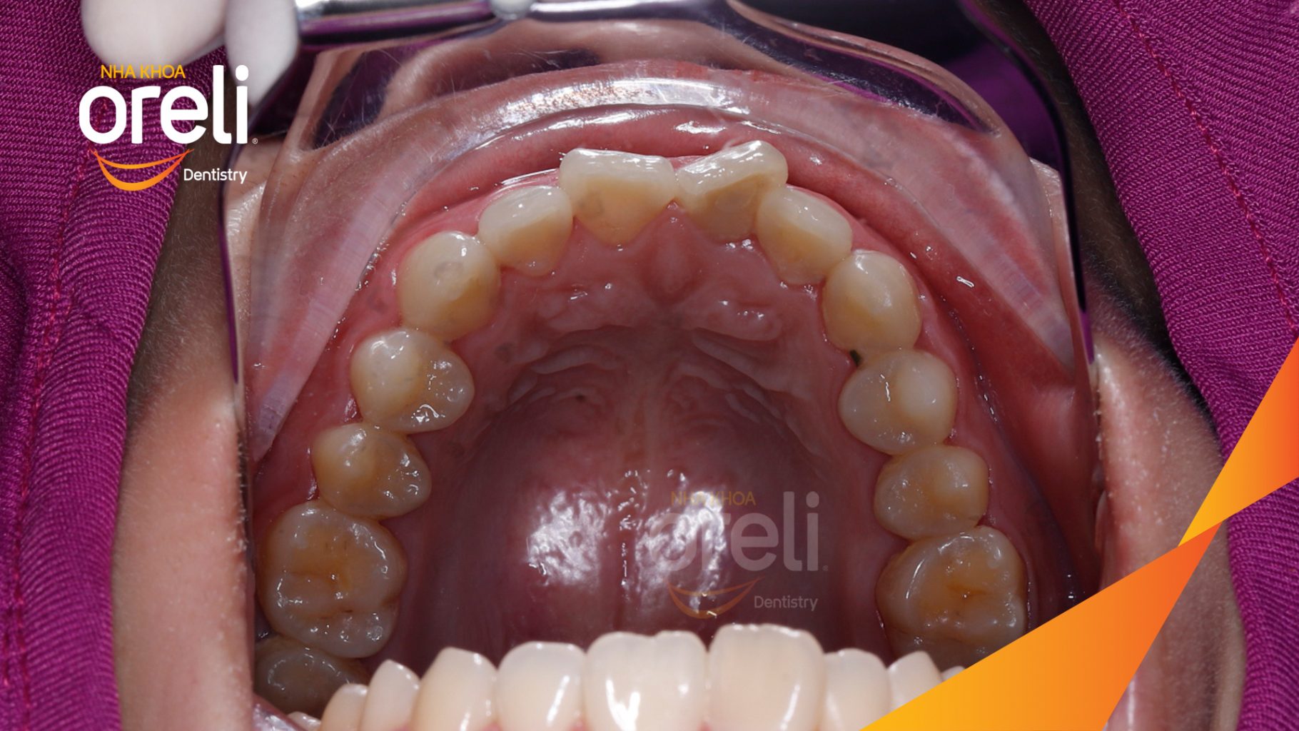 Kết quả sau 2 năm: Khớp cắn đúng nụ cười đẹp tại Nha khoa Oreli