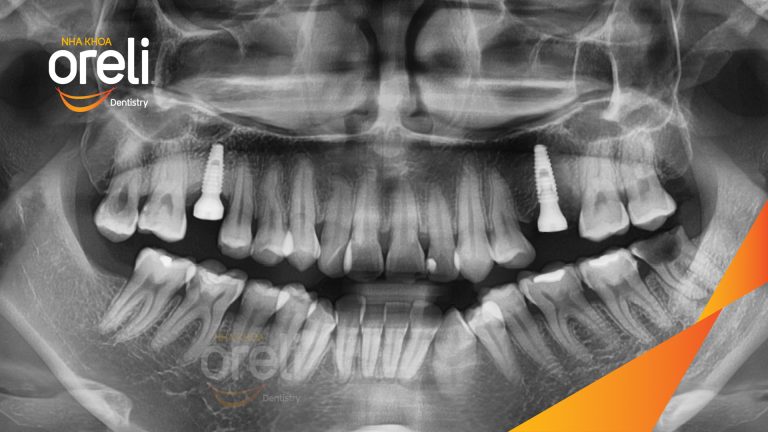 Ca Cấy Ghép Implant Hàm Dưới – Case thực tế tại Oreli