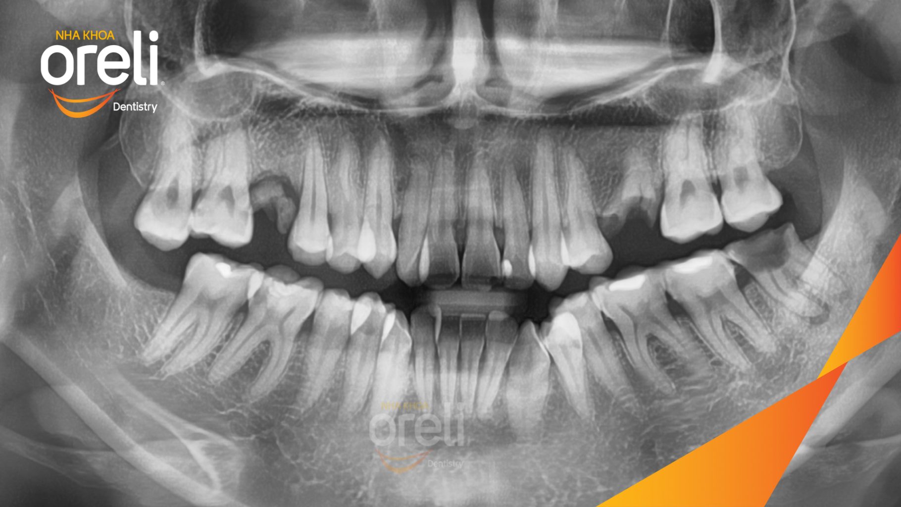 Trước điều trị: Mất răng hàm dưới tại Oreli