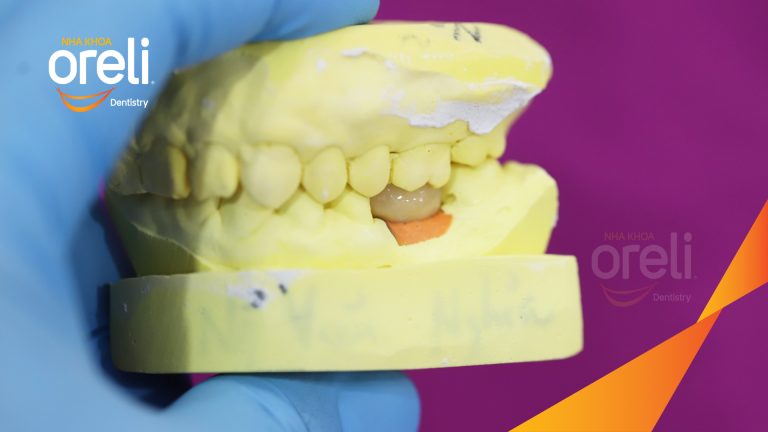 Ca Cấy Ghép Implant Phục Hồi Răng Tại Nha Khoa Oreli