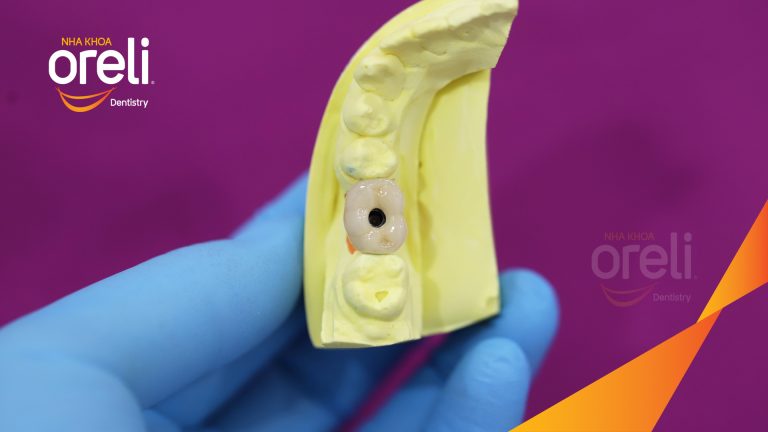 Ca Cấy Ghép Implant Phục Hồi Răng Tại Nha Khoa Oreli