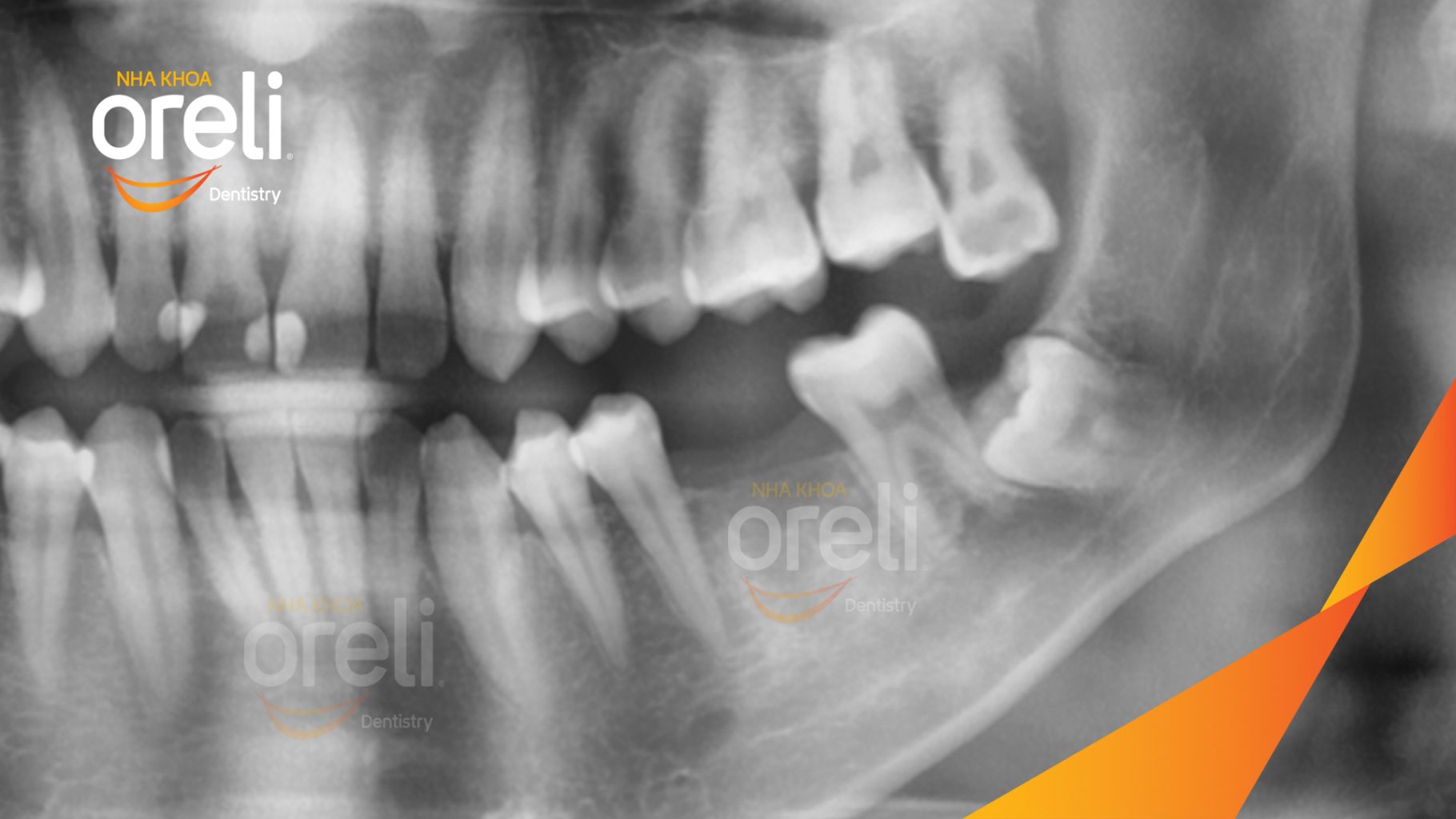 Trước điều trị: Mất răng hàm dưới tại Oreli