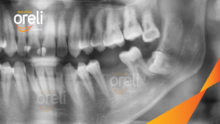 Ca Cấy Ghép Implant Phục Hồi Răng Tại Nha Khoa Oreli