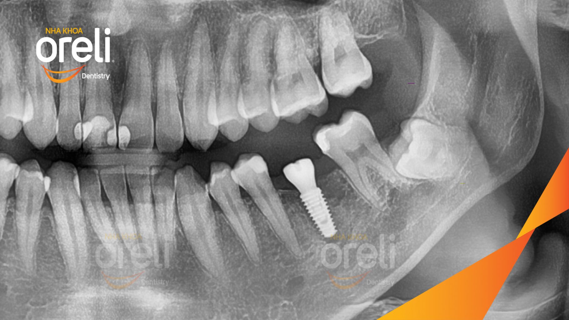Mất răng hàm dưới trước khi điều trị tại Oreli