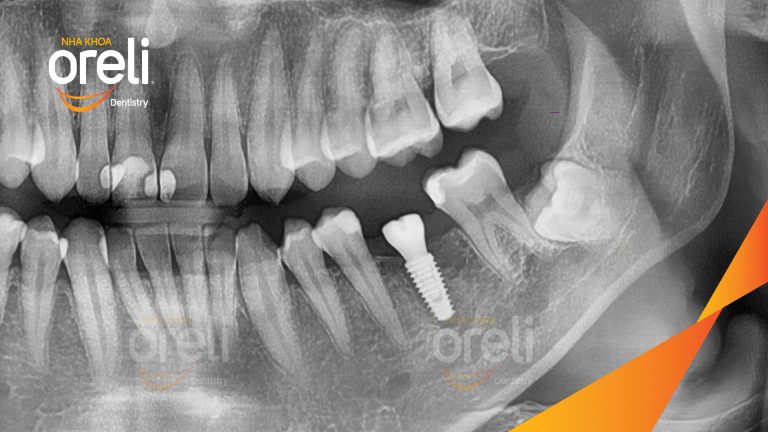 Ca Cấy Ghép Implant Phục Hồi Răng Tại Nha Khoa Oreli