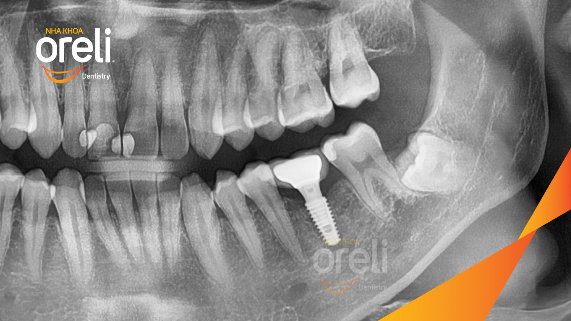 Quá trình Cấy ghép trụ Implant chính hãng vào vùng mất răng trong 3 tháng tại Oreli
