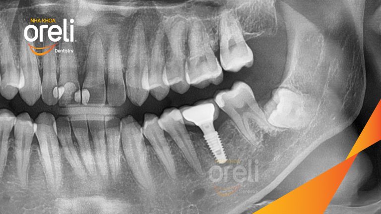 Ca Cấy Ghép Implant Phục Hồi Răng Tại Nha Khoa Oreli